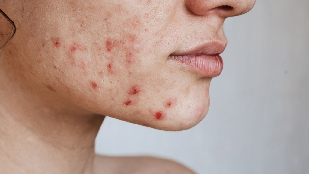 efecto rebrote acne