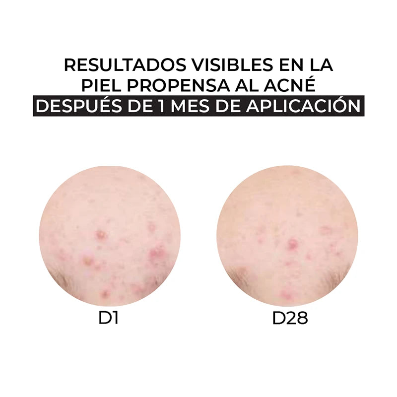 resultados crema para acne