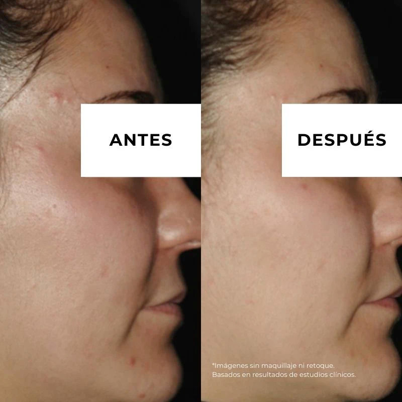 resultados crema antiacne arganour